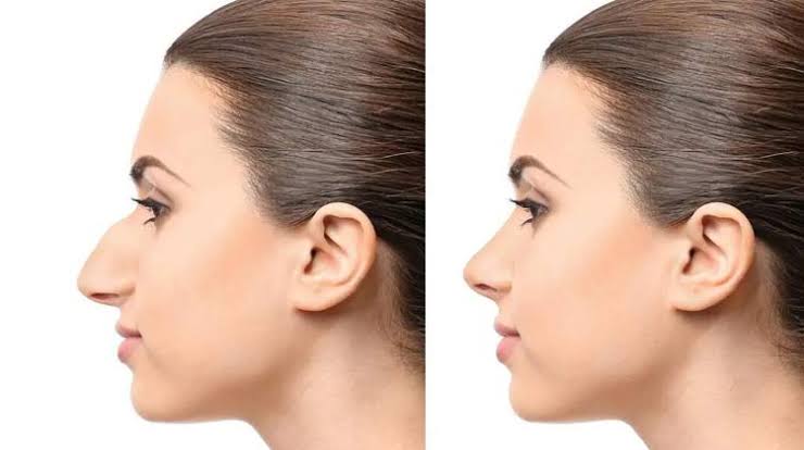 Nose Job Cost in India: Everything You Need to Know