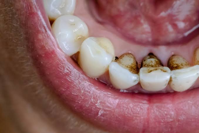How to Remove Black Stains from Teeth Naturally: Effective Tips for a Bright Smile